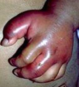 Foot Rash - Symptoms, Causes, Treatments - Healthgrades